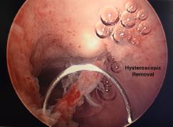 Hysteroscopy-removal